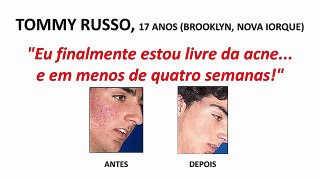 Adeus Acne Funciona? Não Compre Antes de Ver Este Vídeo!