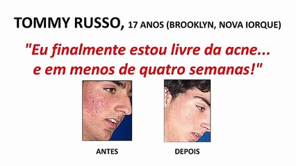 Adeus Acne Funciona? Não Compre Antes de Ver Este Vídeo!