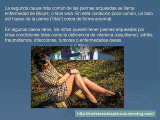 Enderezar las Piernas: tratamiento y prevencion