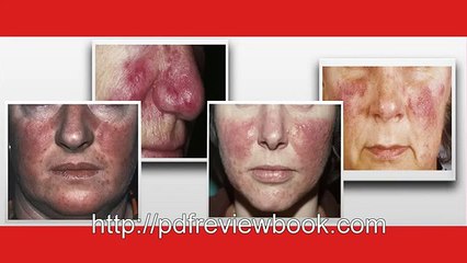 Adios Rosacea | Sorprendente Adios Rosacea | Descarga ahora  libro pdf