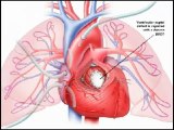Heart Sounds Made Easy - Congenital Heart Defects (480p)
