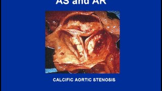 Heart Sounds - Aortic Stenosis and Regurgitation Variations (480p)