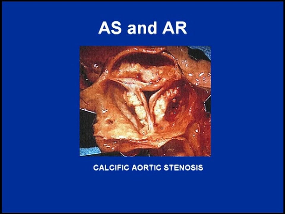 Heart Sounds - Aortic Stenosis and Regurgitation Variations (480p)