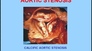 Heart Sounds - Aortic Stenosis vs Aortic Regurgitation (480p)