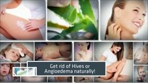 How to cure hives? | How to get rid of hives fast ? | How to treat hives at home?