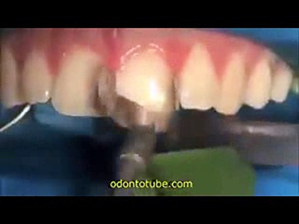 Teeth Treatment - Very Amazing