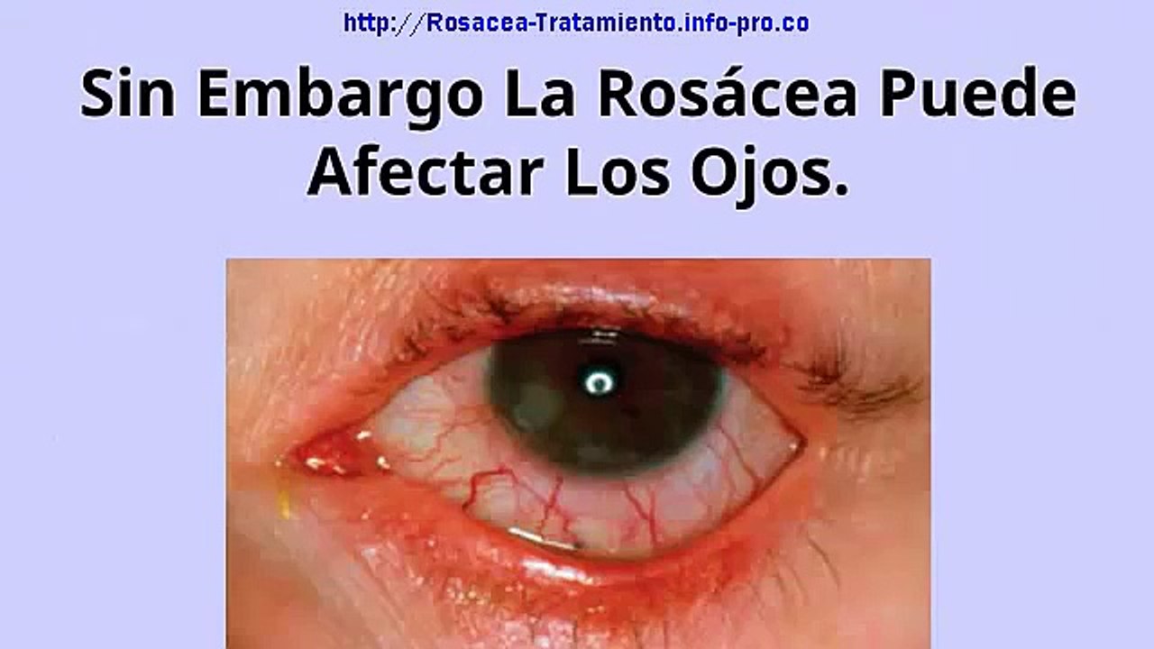 ❤❤❤Cremas Para La Rosacea, Tratamiento Para Una Rosacea, Enfermedad De La Piel Rosacea*