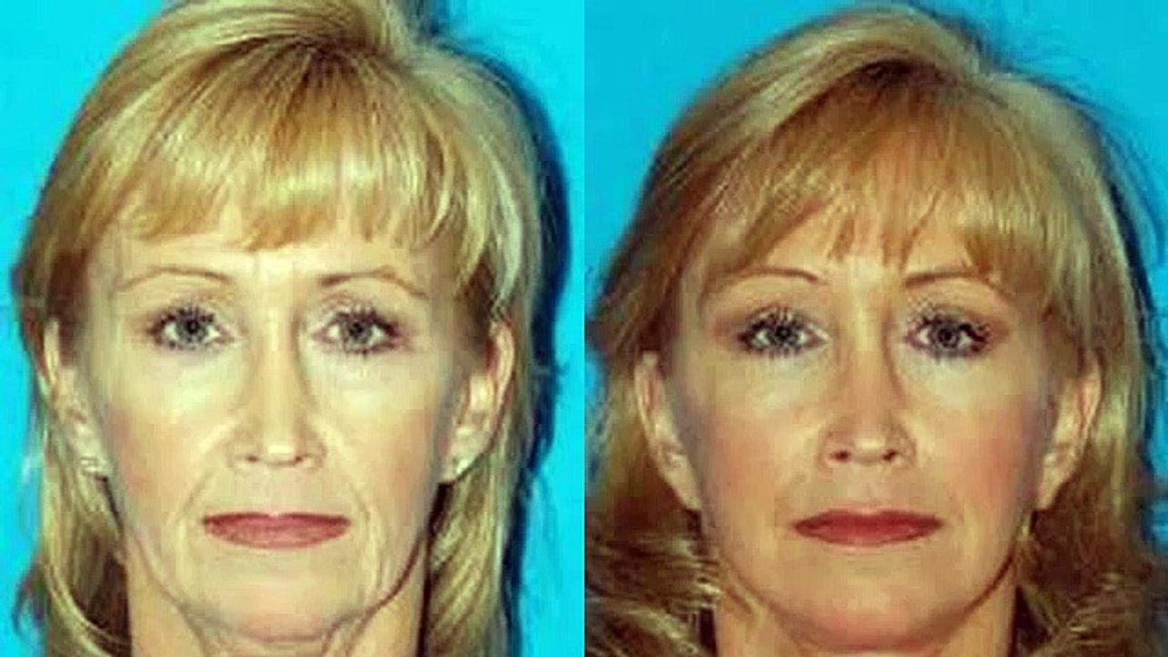 Facelift without surgery homemade beauty tips
