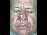 Antenne West Gesundheitsmagazin: Rosacea