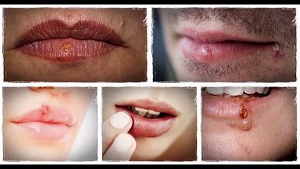 Get Rid Of Cold Sores Fast Reviews-Is It Scam Or Legit?