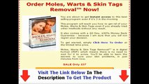 Moles Warts Removal Review | Is Moles Warts And Skin Tags Removal All It's Cracked Up To Be?