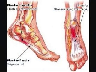 Plantar Fasciitis Relief in 7 Days - REVIEW of - Plantar Fasciitis Relief in 7 Days Program Products