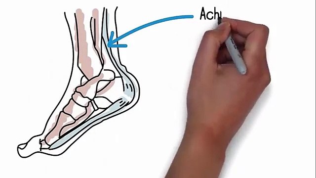 Fast Plantar Fasciitis Cure | Fast Plantar Fasciitis Cure Review