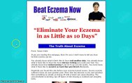 Beat Eczema By Susan Clark Review - Scam or Legit?