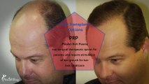 Hair Transplant Options in Istanbul, Turkey