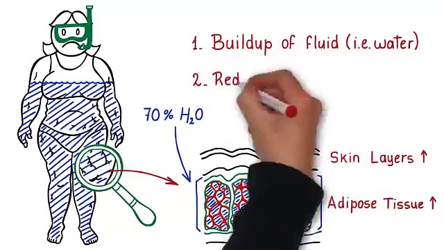 The Cellulite Factor: Natural Cellulite Treatment | Anti Cellulite Treatment: Remedies For Cellulite