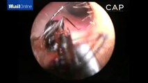 Des médecins indiens ont extrait une colonie de fourmis dans l'oreille d'une fillette de 12 ans
