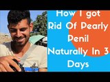 Pearly Penile Papules Removal at Home. Discover how I cured mine in 3 days.