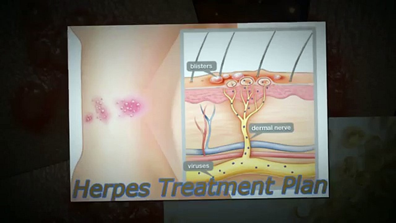 Get Rid Of Herpes Review - 2013 How Can I Get Rid of Herpes?