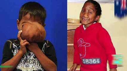 Австралийские врачи удалили нарост с лица филиппинского мальчика