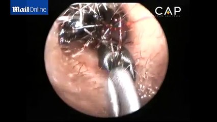 Video Of Young Girl Having 1000 Giant Ants Removed From Her Ears Is Going Viral