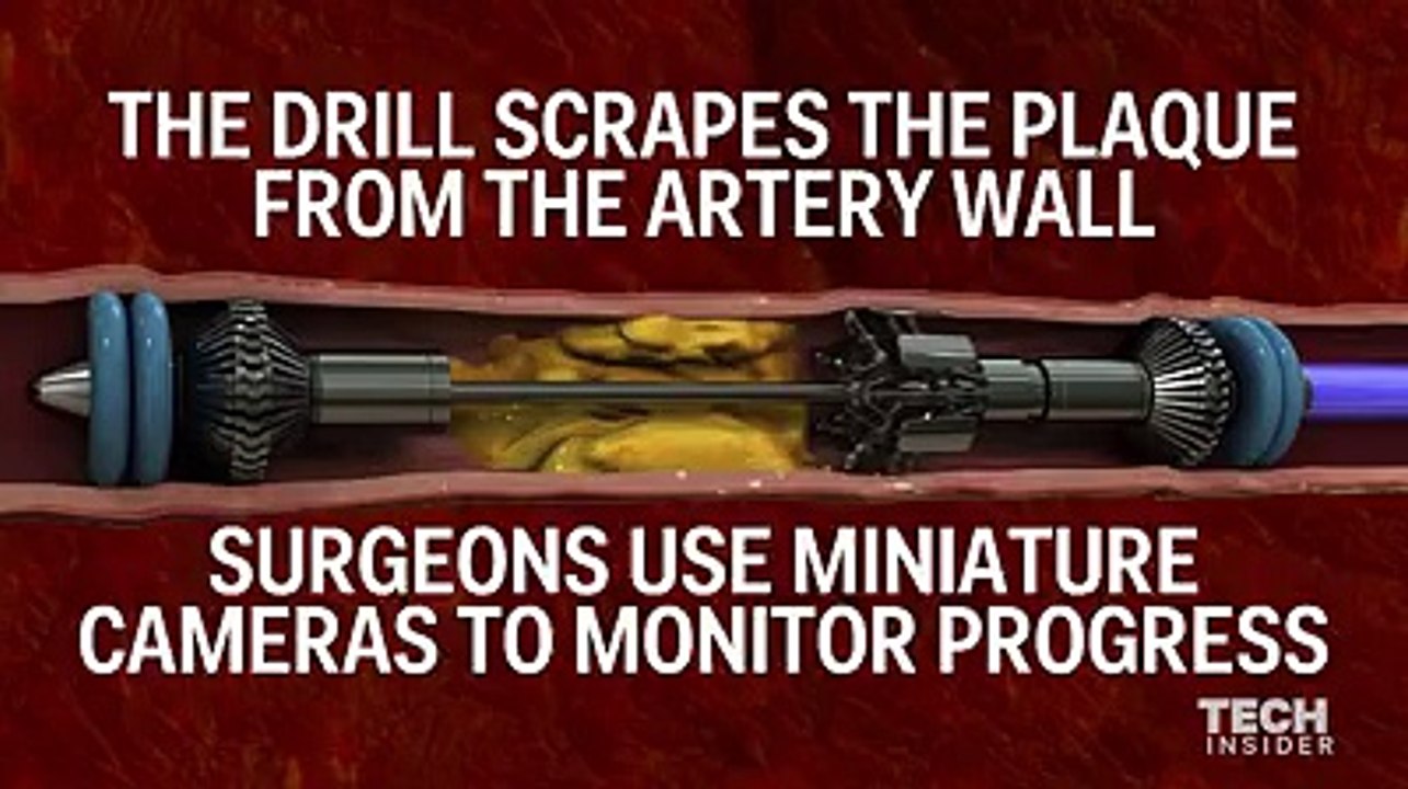 Eat Bad Cholesterol - Concept Device Could