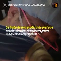 Vea la prótesis que regenera la piel sin dejar casi cicatrices