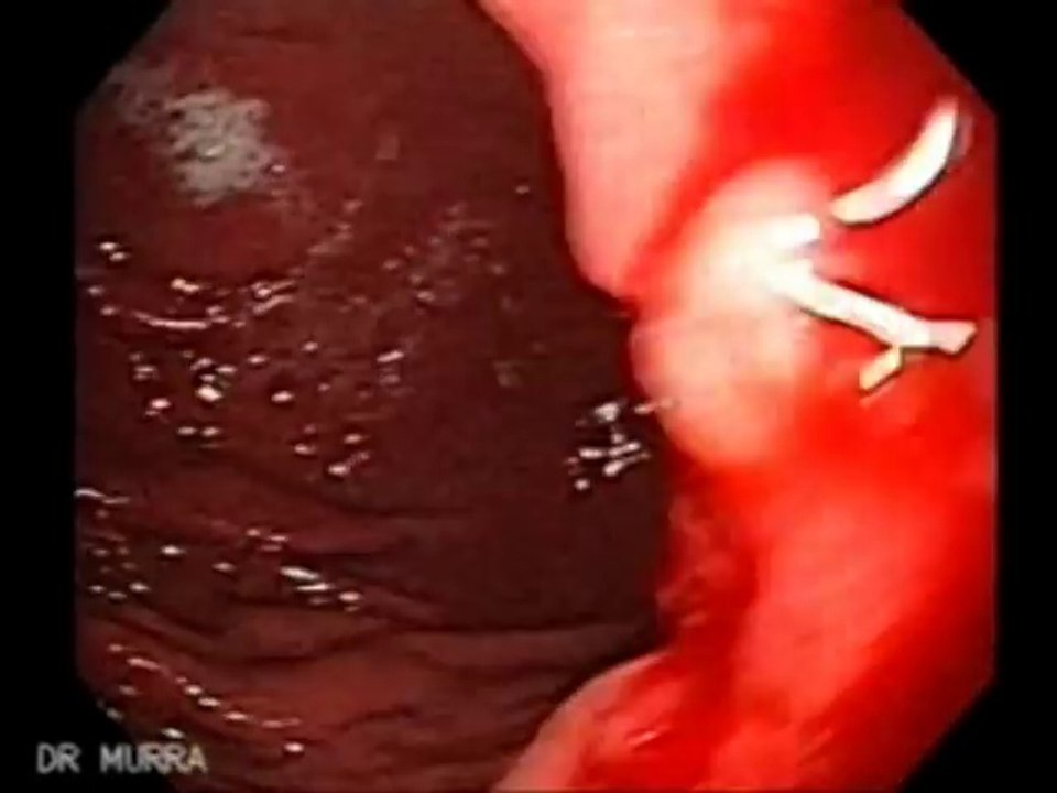 Endoscopia de Cáncer Gástrico Pequeño