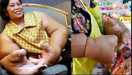 Женщина из Таиланда страдает от непрерывного роста рук