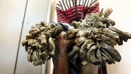 Abul Bajandar, l'homme arbre va etre opéré