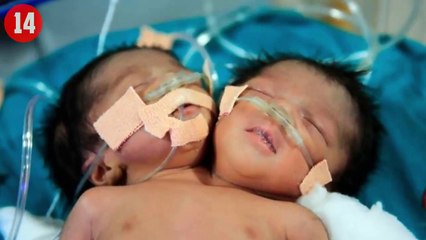 Fazla Organla Doğan 20 İlginç İnsan