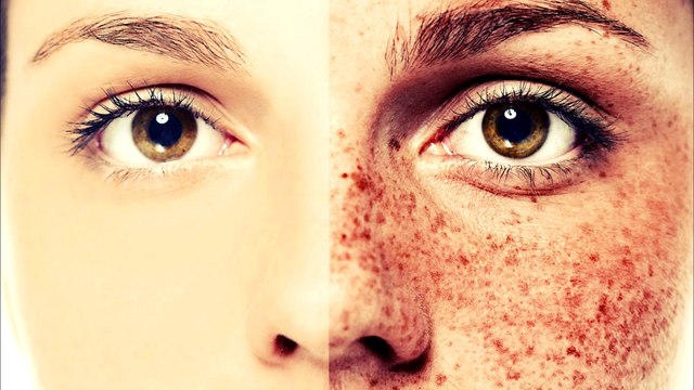 Пилинг. Химический пилинг. Пилинг лица Поверхностный, срединный, глубокий пилинг лица. Эстетическая медицина и косметология.