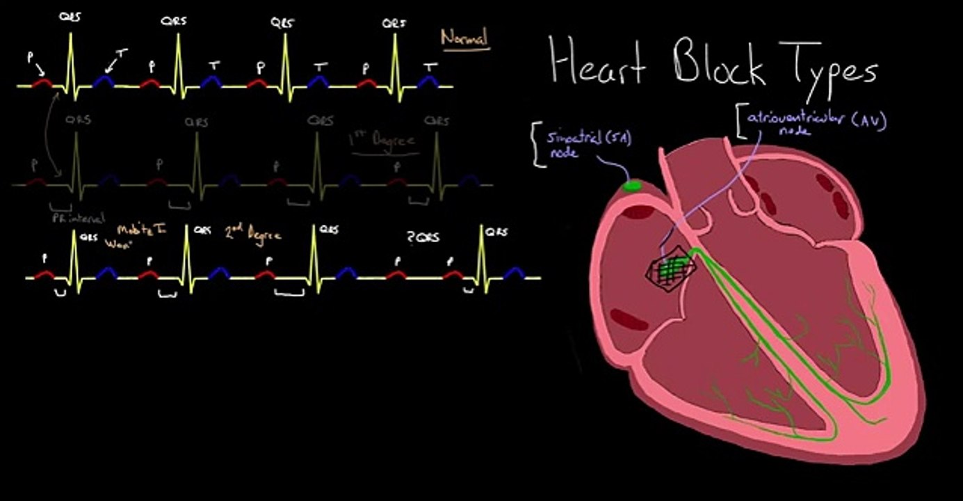 Major Types of Heart Block - Congestive Heart Failure (360p)