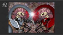 How Repeated Concussions Damage Your Brain Forever