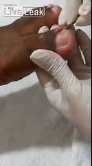 Le médecin découvre deux asticots gesticulant sous son écœurant ongle incarné