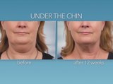 VeinMed Solutions now has Coolsculpting