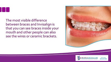 The Visible Difference Between Invisalign and Braces