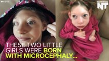 Parents Share Why Their Daughters Born With Microcephaly Are A Blessing