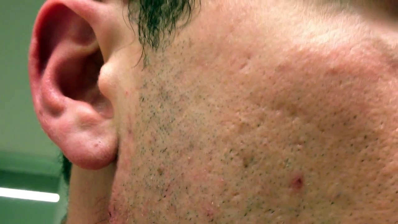 The Longest Grossest Ingrown Hair In History