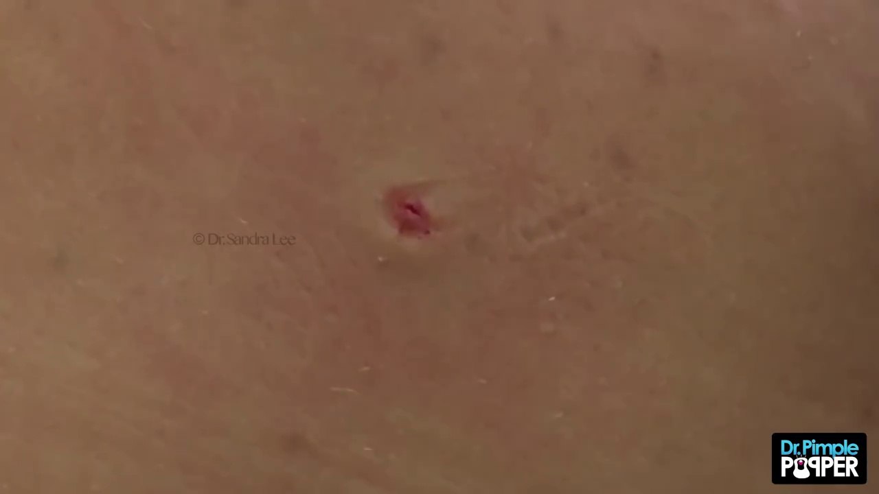 Unusual types of Cysts- Eruptive Vellus Hair Cysts, Part 1 in a Series