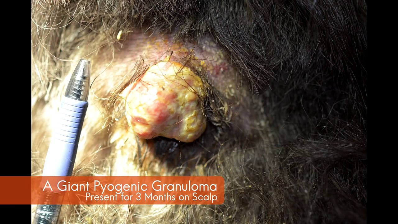 A Giant Pyogenic Granuloma