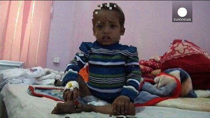 Download Video: Yemen: Unicef, oltre un milione di bambini a rischio malnutrizione acuta