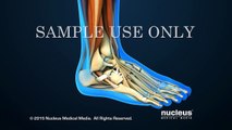 Arthroscopic Ankle Fusion Surgery (Arthrodesis)