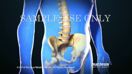 Back Surgery_ Spinal Fusion
