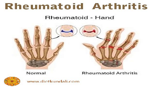 Rhematoid Arthritis Its Causes and Treatment