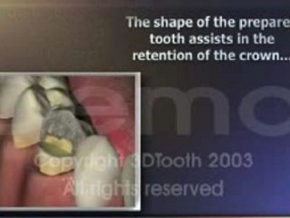 Couronne dentaire : préparation et taille de la dent