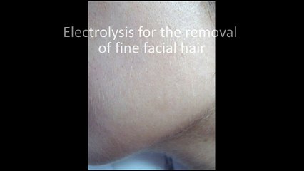 Electrolysis hair removal on the female face.