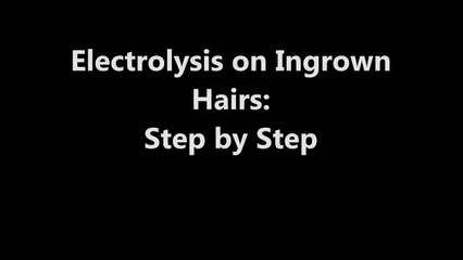 Electrolysis on Ingrown Hairs  Step by Step
