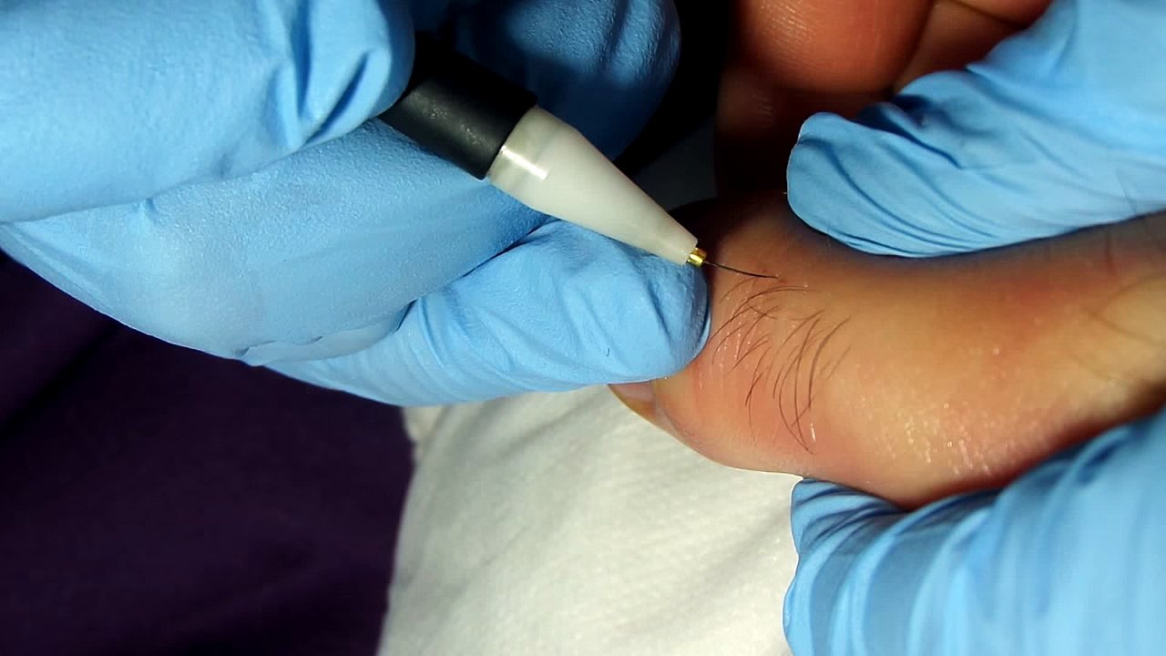 Electrolysis on man finger.