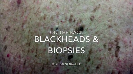 Blackhead extractions & 2 Skin Biopsies